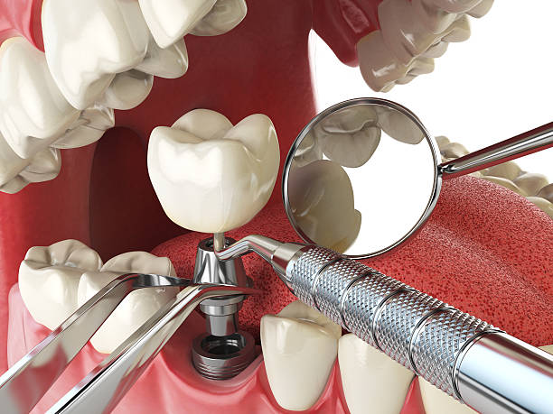 Best Broken or Cracked Tooth Emergency Dentist in Wilsonville, OR